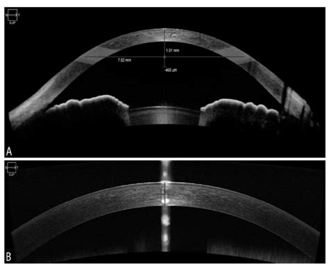 measuring corneal thickness with oct|normal cornea decenterion.